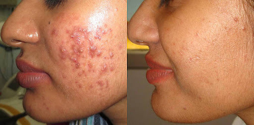 Acne Daag-Dhabbe Ka Ilaj: 13 Effective Skin Care Tips & Best Cream